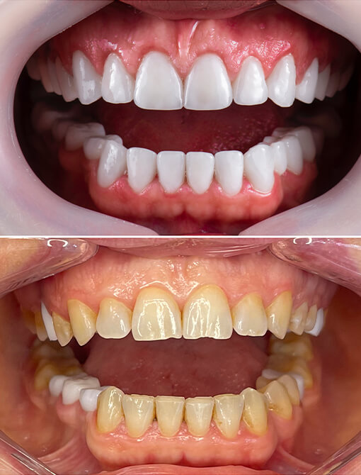 Dental Veneers In Turkey - Queen Clinic In Istanbul 2024