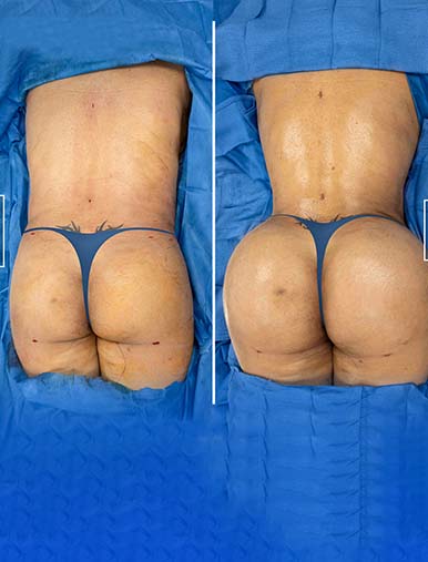 Buttock Lift / Butt Lift - Dr. Turkof - Vienna