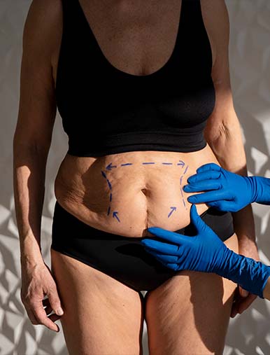 Abdomen perfecto - Beneficios de la abdominoplastia