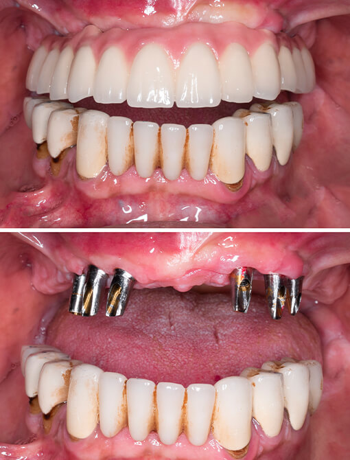 Acquista Set di riparazione temporanea per denti adesivi per