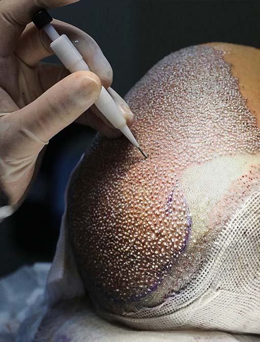 Specialista in Trapianto di Capelli in Turchia che lavora con le ultime metodologie su un paziente durante il processo di ripristino dei capelli nella clinica di trapianto di capelli a Istanbul.