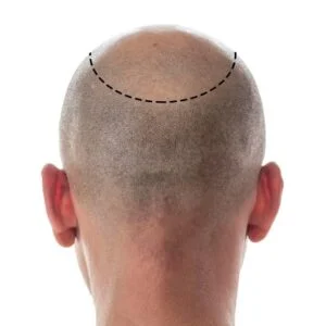 Image illustrating a patient undergoing a hair transplant in Turkey at Queen Clinic.