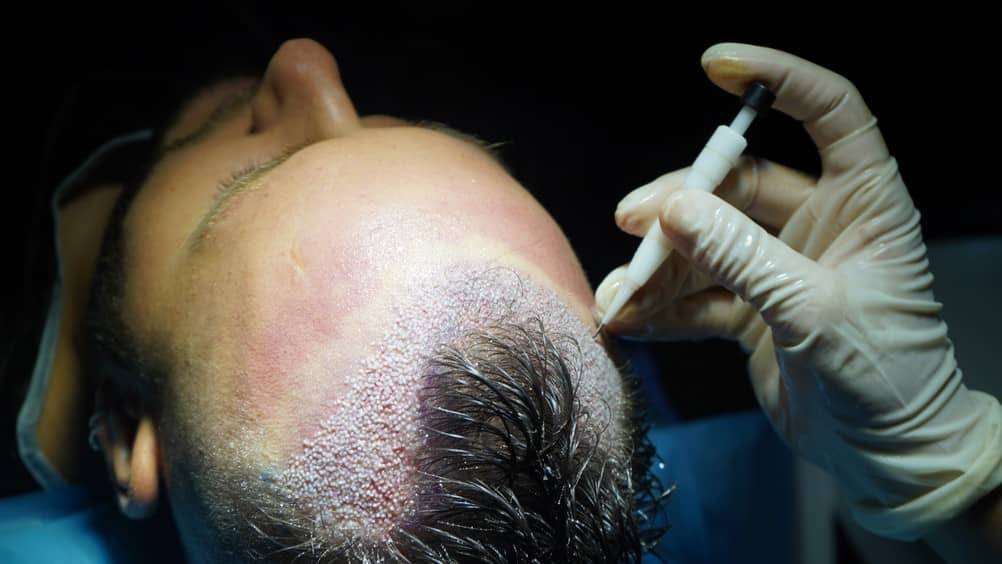 Immagine che illustra un intervento di trapianto di capelli FUE in Turchia